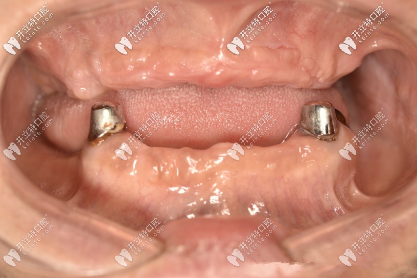 多年前在上海鼎植口腔做穿顴穿翼種植的高叔叔,現(xiàn)在如何了