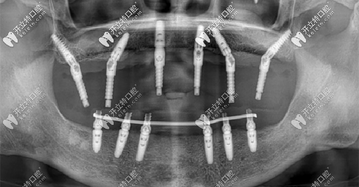 穿顴穿翼種植技術(shù)