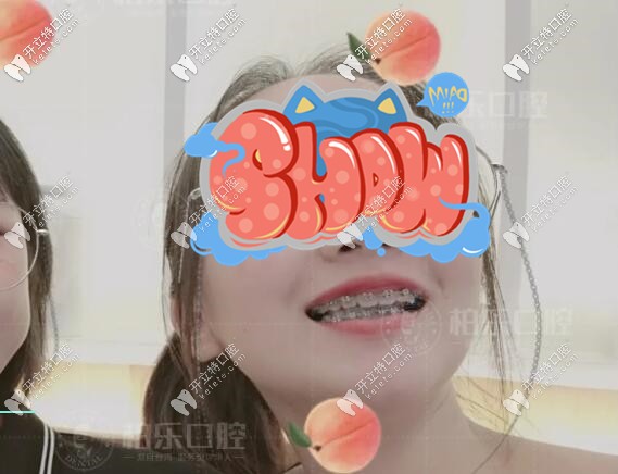 柏樂口腔矯正成功案例