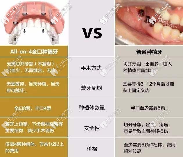 All-on-4種植牙與普通種植牙的區(qū)別