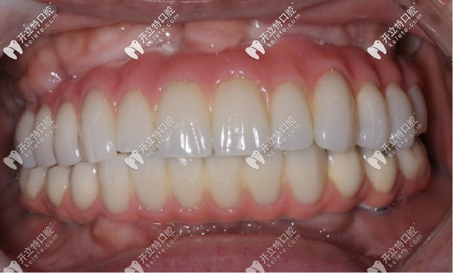 當(dāng)天就了全口牙