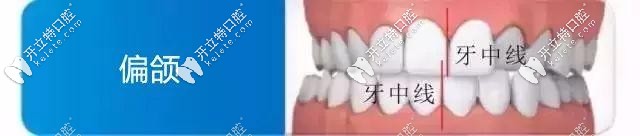 中線對(duì)齊才是正確的牙齒關(guān)系