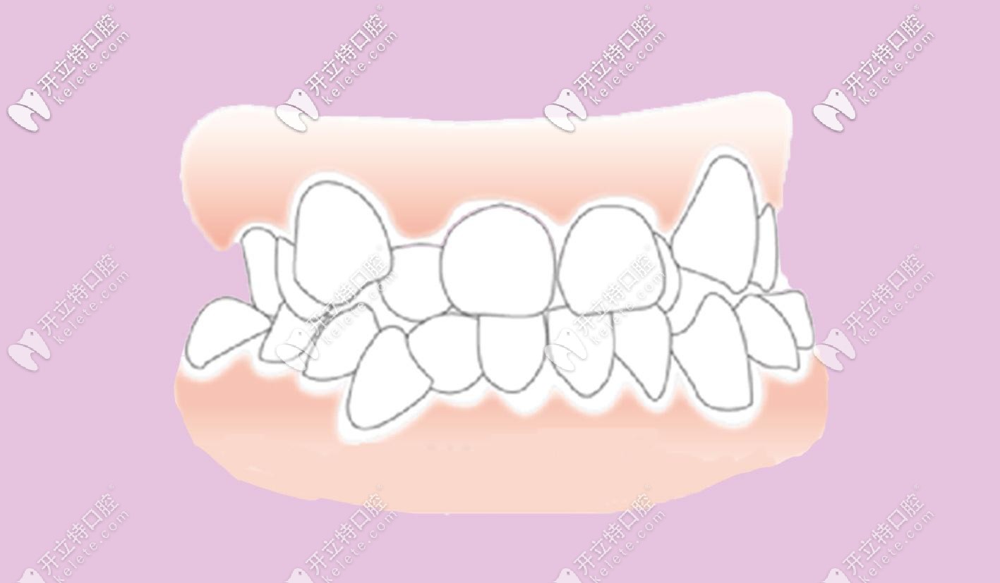 正確的咬合關(guān)系