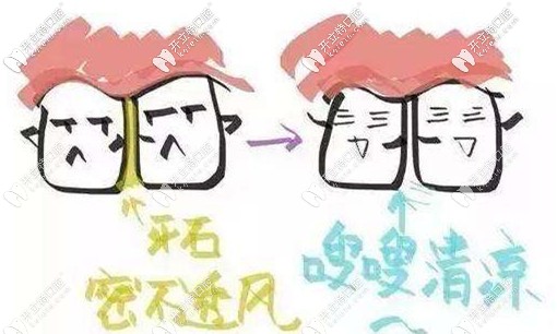 每年定期潔牙可以預(yù)防牙縫大