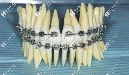 直絲弓矯正技術