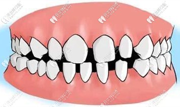 牙縫變大可以自己縮小么？教你讓牙縫變小的小技巧