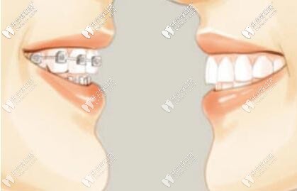 深挖mbt直絲弓矯正技術(shù)費用很貴嗎?矯牙戴它好嗎