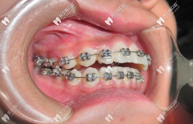 MBT矯正口內(nèi)照片