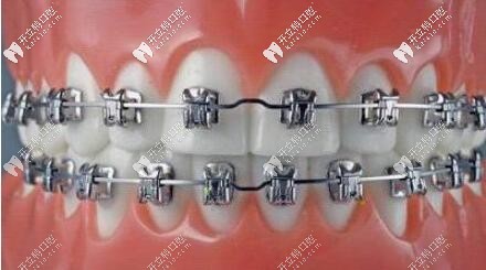 MBT直絲弓矯正的缺點(diǎn)