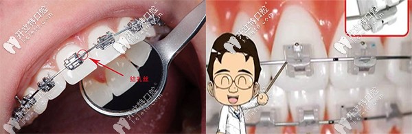 自鎖托槽與普通托槽的區(qū)別到底在哪