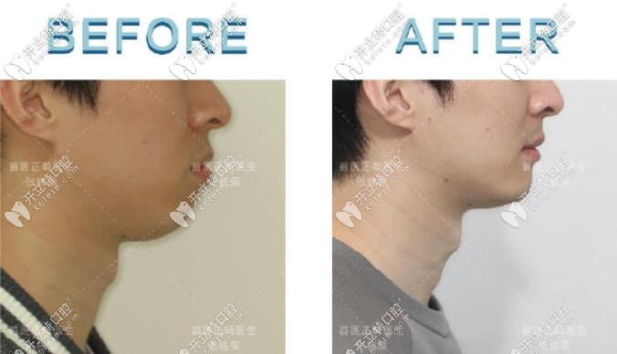 來(lái)看看張棟梁矯正效果怎么樣