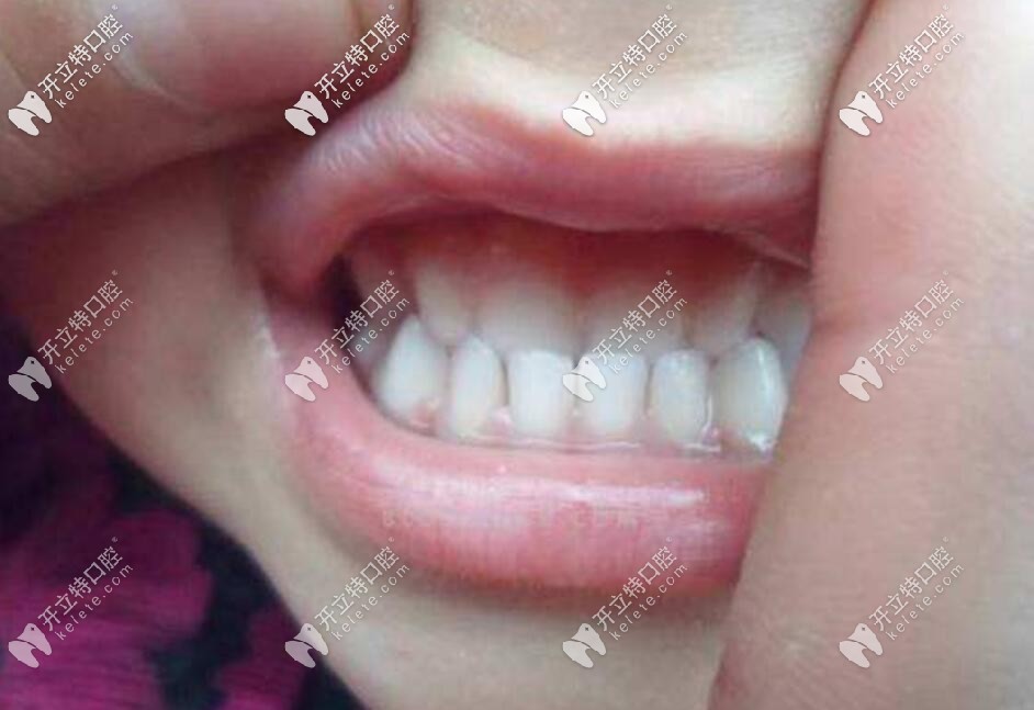 正畸較快多久能摘牙套？需要等到什么程度才可以取下