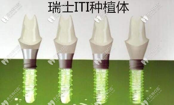 瑞士 ITI瑞鋯種植牙