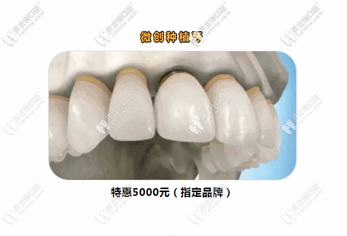 晉江維樂口腔開診期間做韓國登騰種植牙價格只需5000元起嘍!