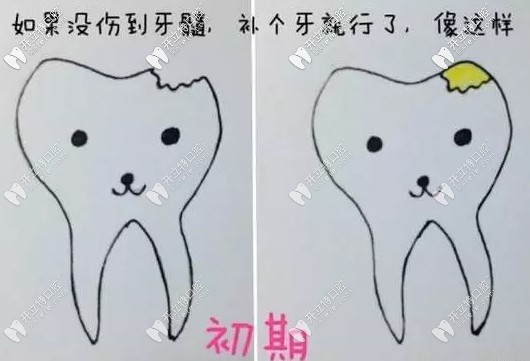 沒(méi)傷到牙髓只需補(bǔ)牙不要隨便做根管治療