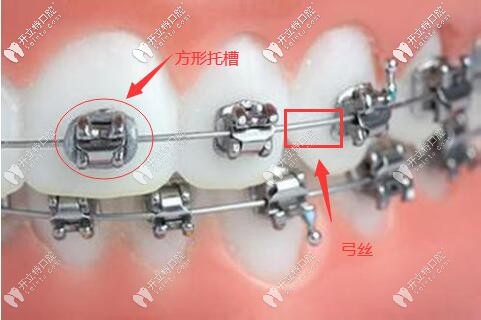 金屬托槽矯正器結(jié)構(gòu)