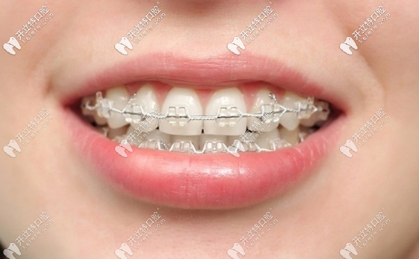 成都新橋口腔牙齒矯正價(jià)格列表