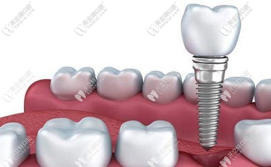 美國3I的種植體價(jià)格因不同型號而不同
