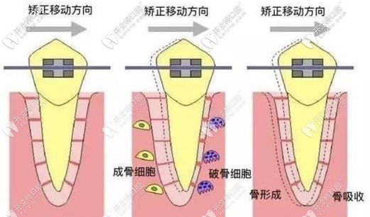 矯正過程中牙齒移動的方向