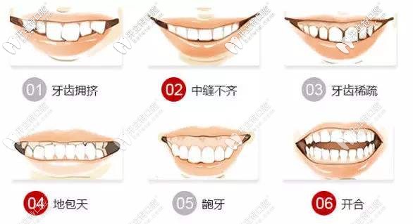 哪些人適合做牙齒矯正
