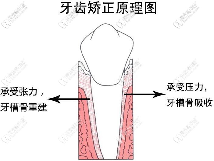 牙齒矯正的原理圖