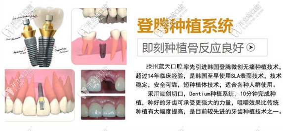 登騰種植體的特點(diǎn)