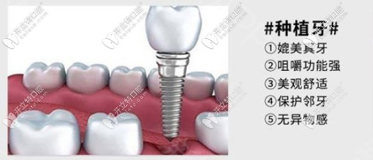 種植牙的優(yōu)勢(shì)