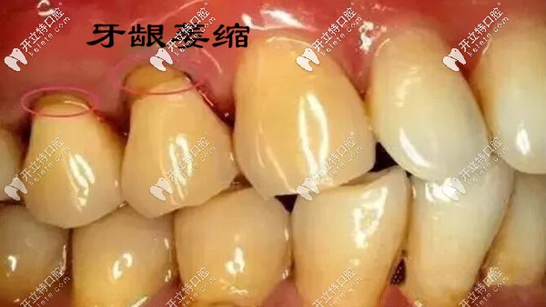 牙齒越來越長怎么辦