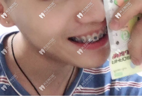 真是后悔沒早點(diǎn)做深覆蓋矯正 真是后悔沒早點(diǎn)做深覆蓋矯正