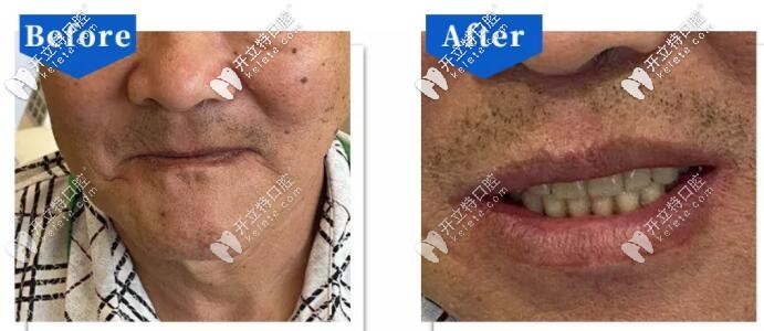 北京中諾口腔做吸附性義齒案例前后效果對(duì)比