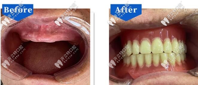 全口吸附義齒修復(fù)前后對(duì)比照