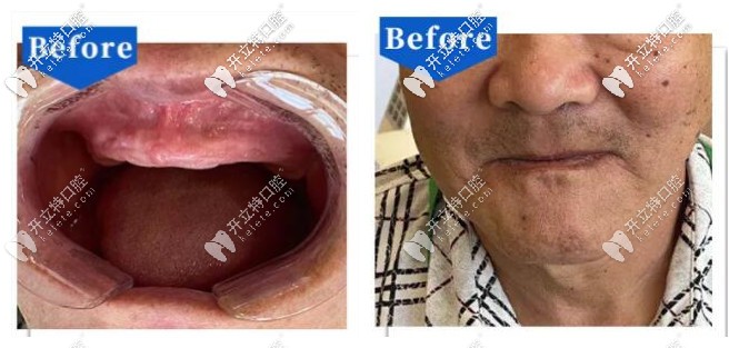 69歲牙槽骨萎縮嚴重的老人做了全口吸附性義齒當(dāng)天啃蘋果