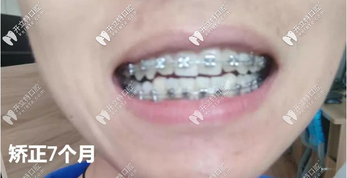 東莞固德口腔做牙齒矯正的價(jià)格 東莞固德口腔做牙齒矯正的價(jià)格