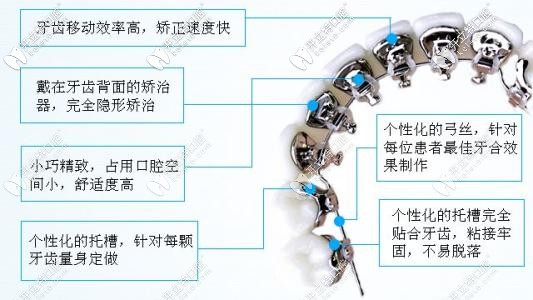 舌側(cè)矯正的優(yōu)勢