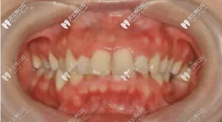 深覆蓋牙齒可以矯正嗎 深覆蓋牙齒可以矯正嗎