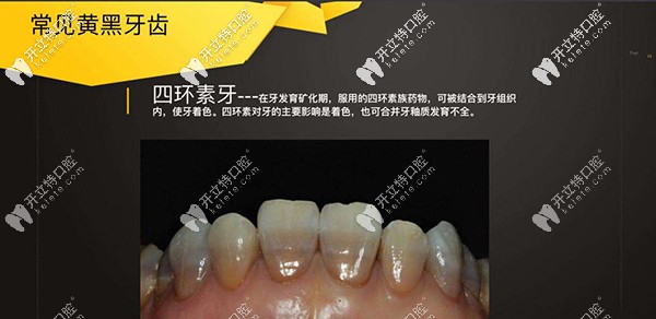 做四環(huán)素牙牙齒漂白多少錢？做出來不知道效果好不好？