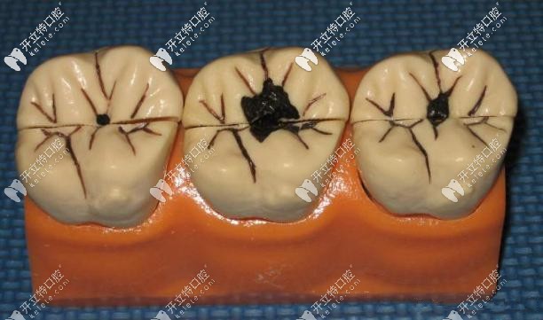 齲壞分為淺齲中齲及深齲