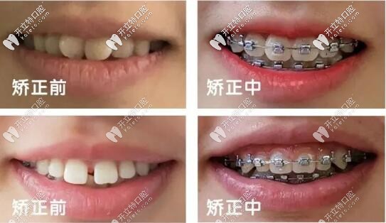 牙齒矯正過(guò)程變化圖