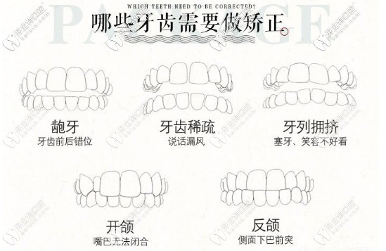 哪些牙齒需要牙齒矯正
