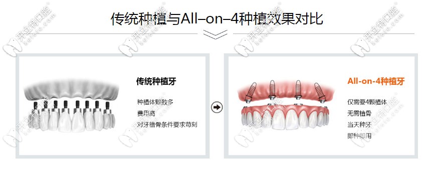 allon4種植牙的優(yōu)勢