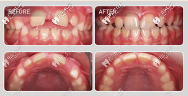 桂林瑾帆口腔兒童牙齒矯正案例