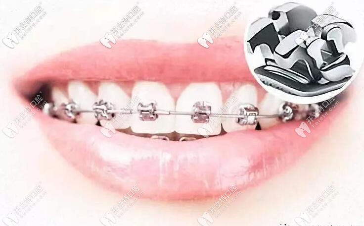 貴陽(yáng)口腔牙齒矯正價(jià)目表:參考自柏德/利美康/德韓正畸價(jià)格