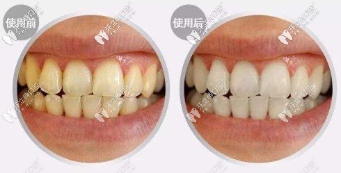 冷光美白牙齒價格