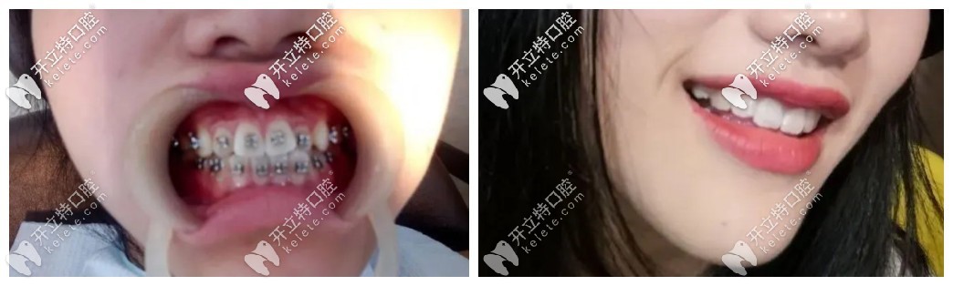 門牙有點(diǎn)外凸可以做國(guó)產(chǎn)普特第五代自鎖托槽來(lái)矯正哦