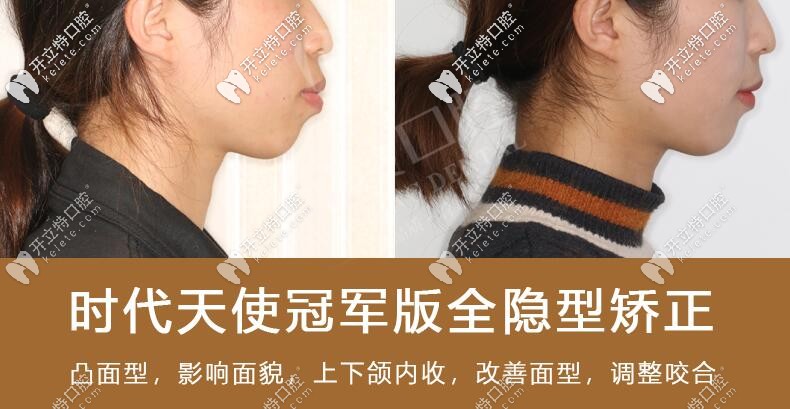  我骨性嘴凸戴時代天使雙膜牙套矯正后牙齒內(nèi)了收5mm