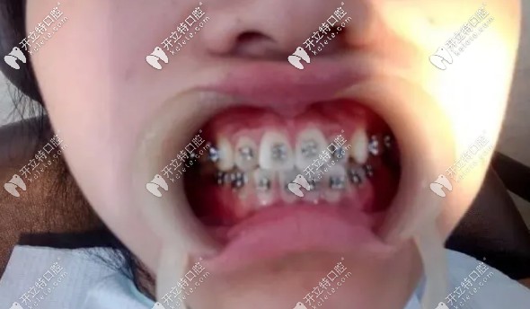 剛帶上托槽的照片