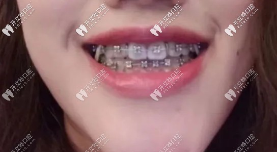 這張應(yīng)該是戴了一年左右的時(shí)候拍的