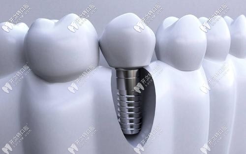 種植牙側面解析圖