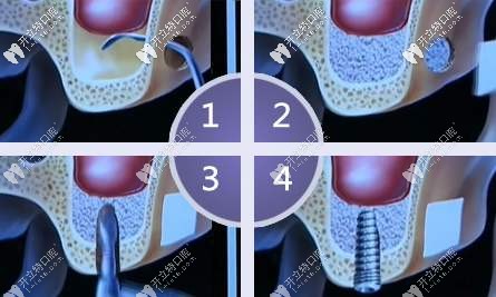 種植牙放骨膠原好還是骨粉好