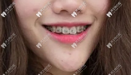 兩年多了，該摘掉牙套啦